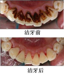 潔牙案例6